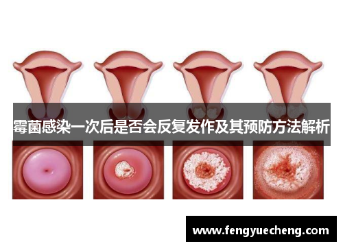 霉菌感染一次后是否会反复发作及其预防方法解析